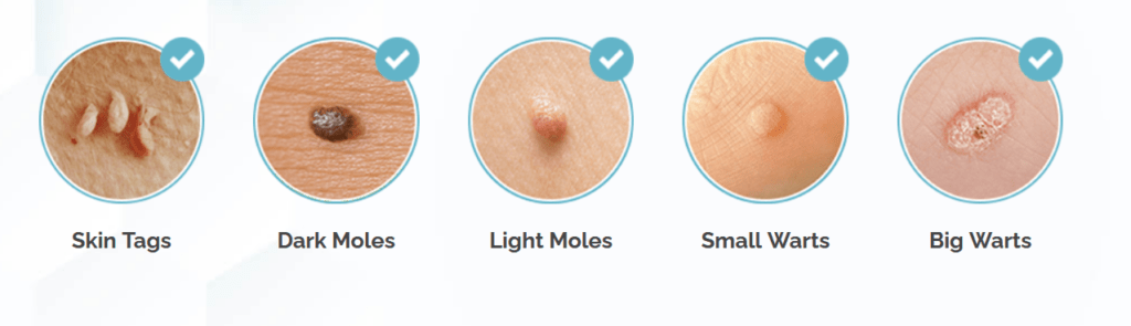 Mole & Skin Tag