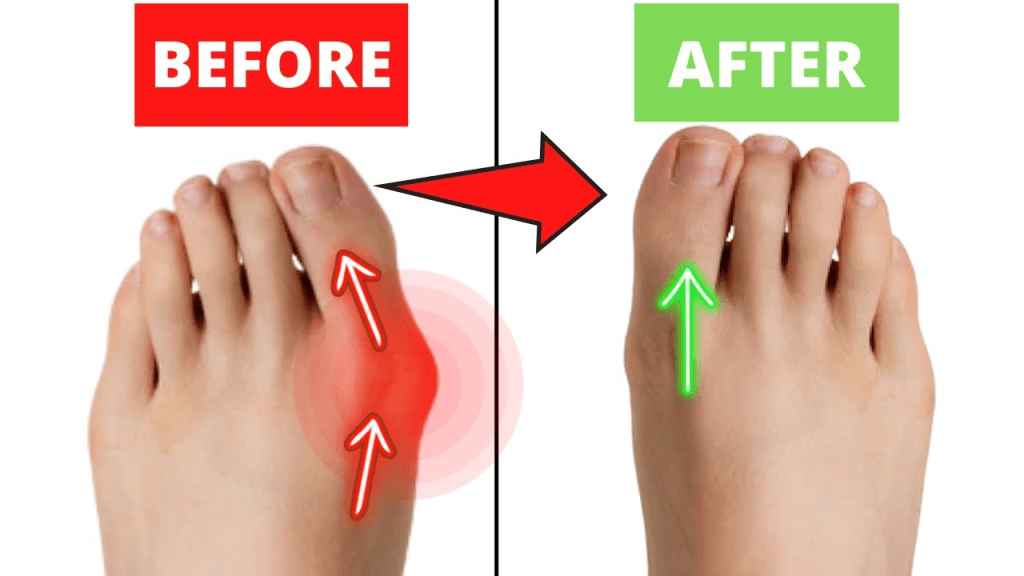 before after bunions